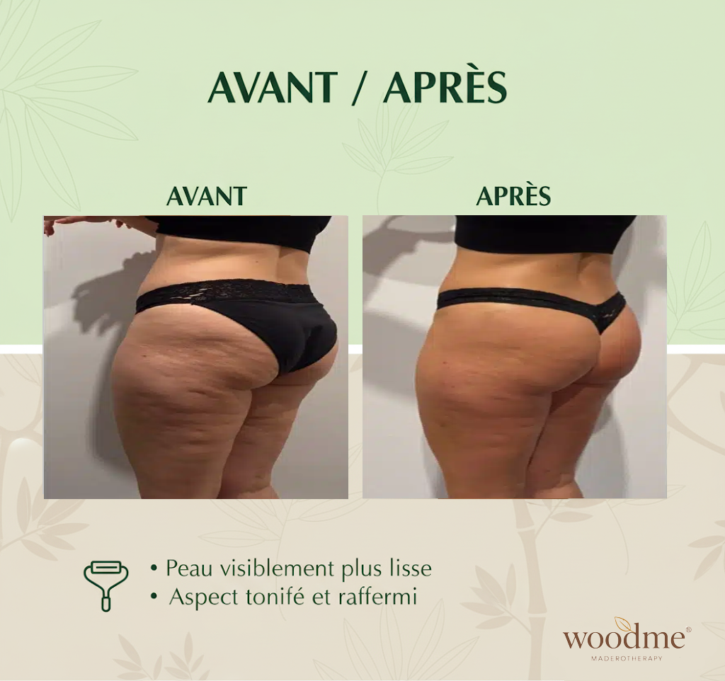 Woodme - Maderotherapie-Set